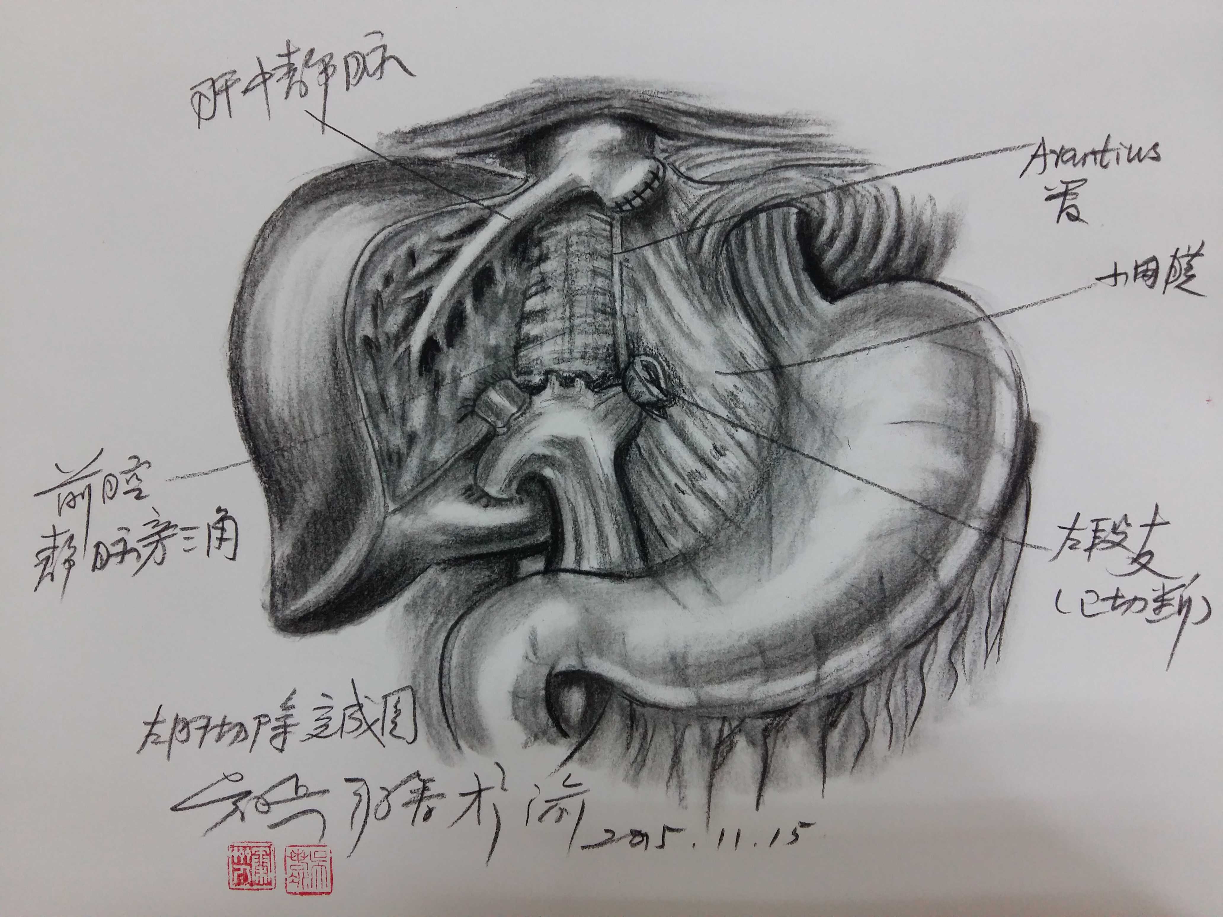  吴小兵：素描肝左段切除术 手绘图